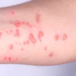 mpox